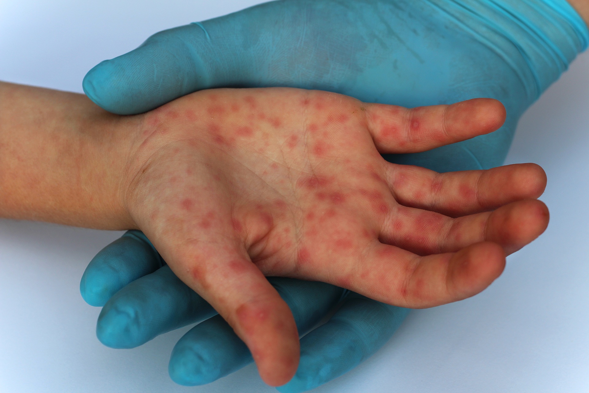 Lee más sobre el artículo Alerta de sarampión: 1.700 vacunas gratuitas fueron aplicadas en ‘zonas rojas’
