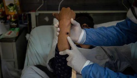 Lee más sobre el artículo El 90% de los casos de viruela del mono están en Santa Cruz; Oruro confirma su primer paciente